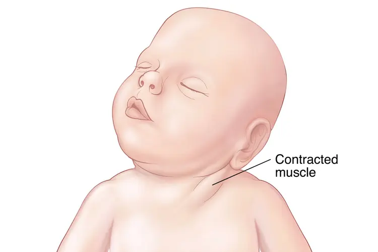 Torticollis and plagiocephaly