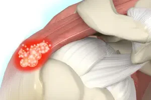 Shoulder Calcification