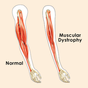 Muscular dystrophy