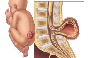 Spina Bifida
