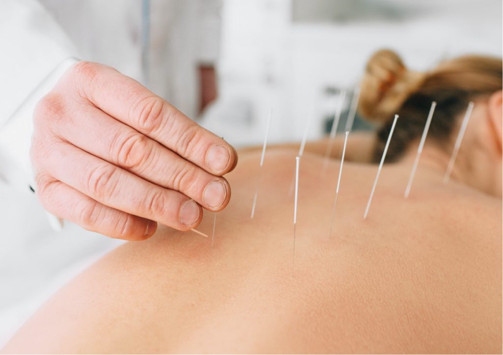 Dry Needling & Acupuncture