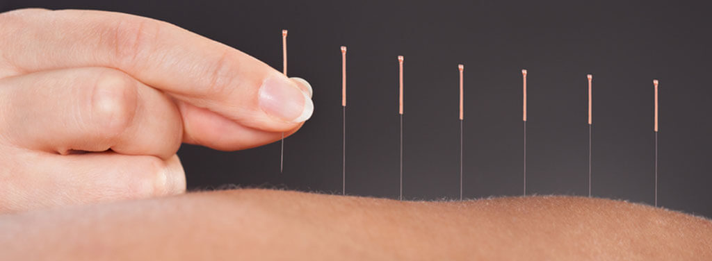 Dry Needling