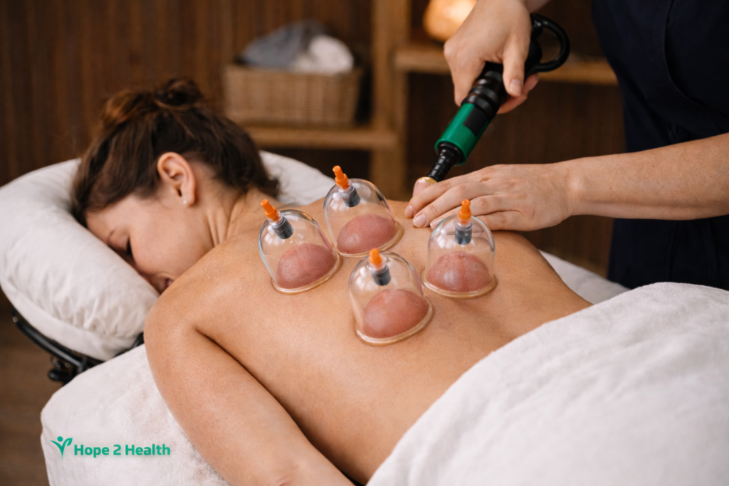 Cupping Therapy in London Ontario