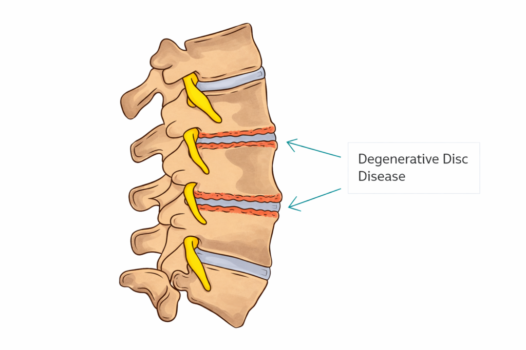 Degenerative Disc Disease
