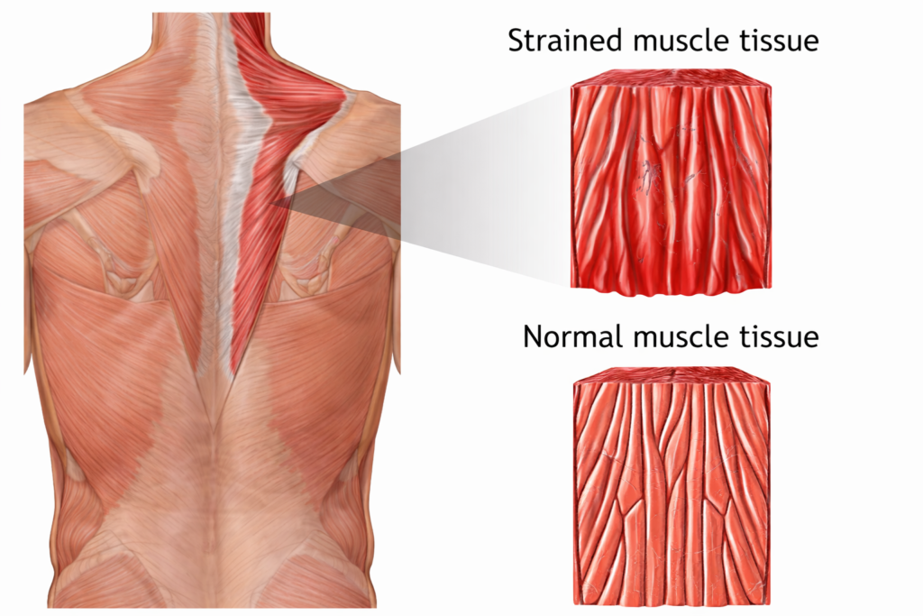 Muscle or Ligament Strain