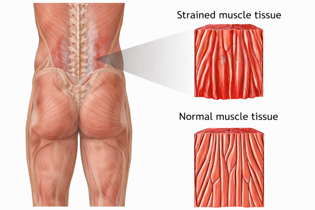 Muscle or Ligament Strain Lower back
