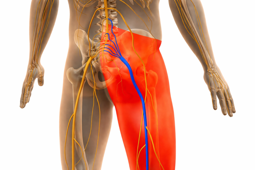 Sciatica (Nerve Compression)